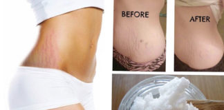Coconut Oil for Stretch Marks During Pregnancy coconut oil for stretch marks