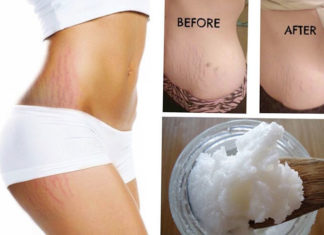 Coconut Oil for Stretch Marks During Pregnancy coconut oil for stretch marks