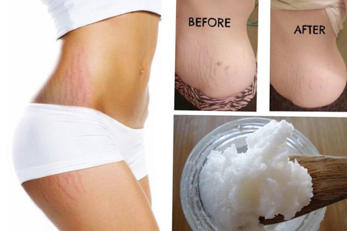 coconut oil for stretch marks