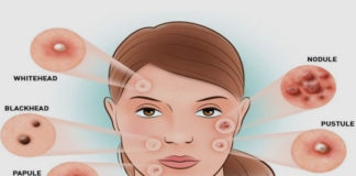 What are hormonal acne and pimples on face hormonal acne and pimples