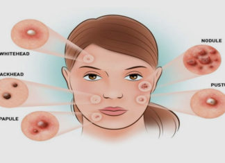 What are hormonal acne and pimples on face hormonal acne and pimples