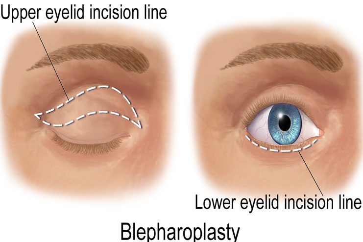 Why do we have Bags under eyes? Causes and remedies that