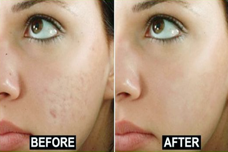 Pigmentation and Dark Spots