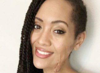 10 Super-Effective Home Remedies For Facial Scars – Stop The Scars! Facial Scars