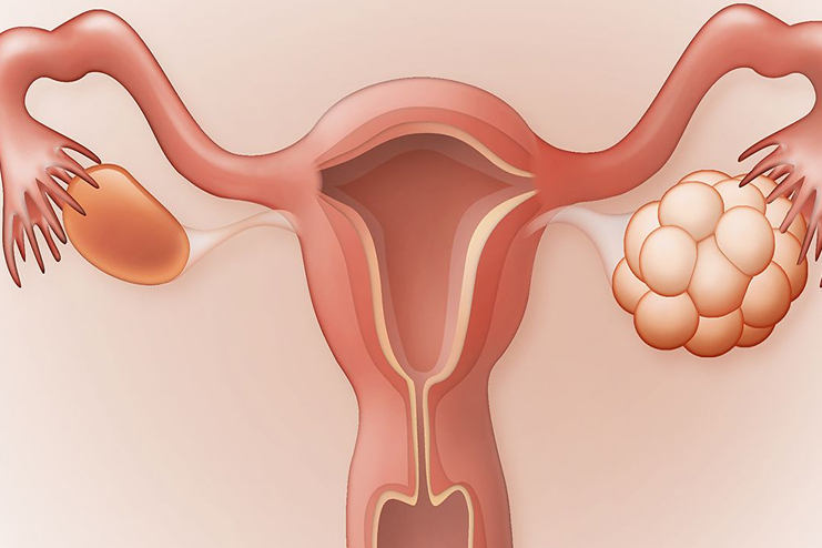 Endocrine Disorder