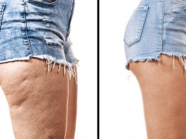 How To Lose Thigh Fat – Learn Best Tips And Make Your Thunder Thighs Thin! Lose-Thigh-Fat