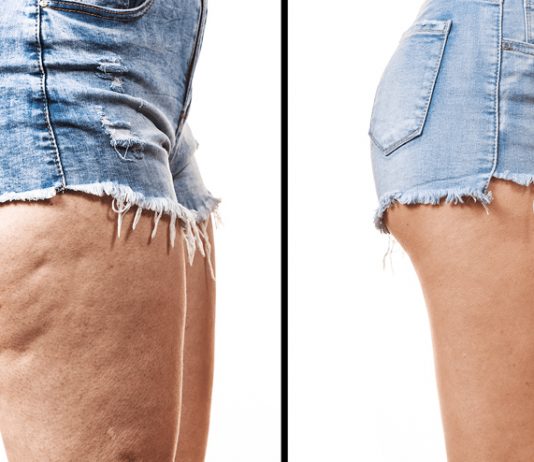 How To Lose Thigh Fat – Learn Best Tips And Make Your Thunder Thighs Thin! Lose-Thigh-Fat