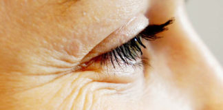 Best Ways to Get Rid Of Crow’s Feet Around Eyes-Causes, Prevention And Treatment! Crows-Feet-around-Eyes