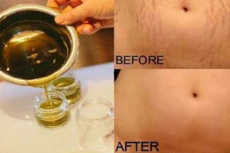 Castor Oil for Stretch Mark