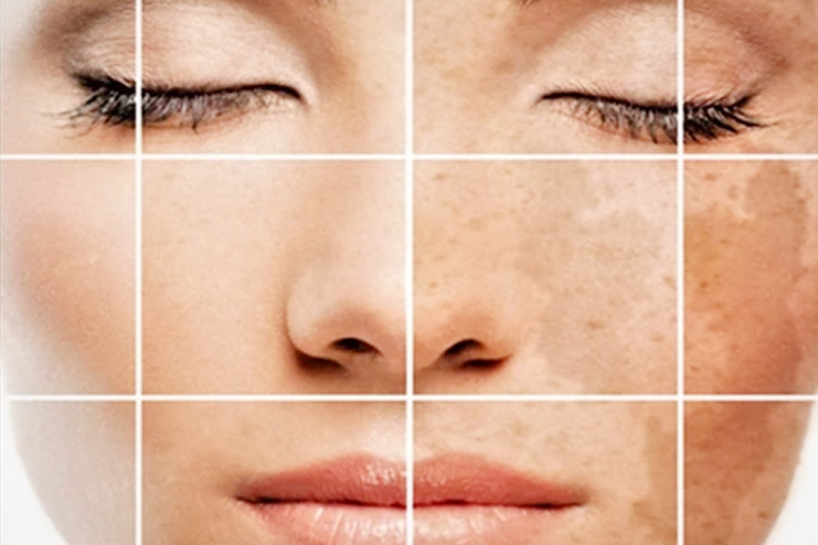 Hyperpigmentation