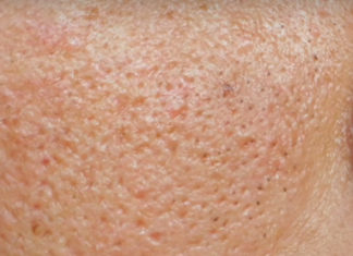 12 Sure Remedies To Minimize Large Pores – Make Them Vanish! Large-Pores