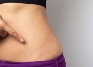 Castor Oil for Stretch Marks – Explore Its Effectiveness Stretch-Marks