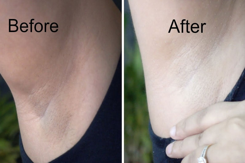 There are dozens of under arm whitening creams out there, to make the right...