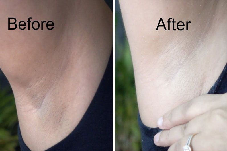 asavea whitening cream side effects