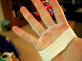 15 Easy Ways To Remove Calluses – Help Your Skin Heal! 15 Easy Ways To Remove Calluses