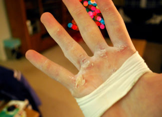 15 Easy Ways To Remove Calluses – Help Your Skin Heal! 15 Easy Ways To Remove Calluses