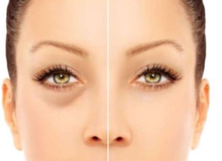 Sunken Eyes – Causes, Prevention And 20 Ways To Get Rid Of It! Sunken Eyes