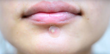 10 Best Rated Pimple Patches That Will Work On Your Skin! 10 Best Rated Pimple Patches That Will Work On Your Skin