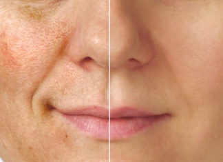 10 Effective Pigmentation Creams To Eliminate Spots On Your Skin! 10 Effective Pigmentation Creams To Eliminate Spots On Your Skin