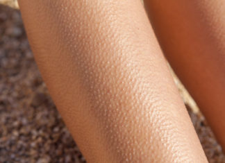 Bumps After Waxing – 8 Best Solutions That Will Help! Bumps-After-Waxing