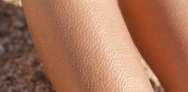 Bumps After Waxing – 8 Best Solutions That Will Help! Bumps-After-Waxing