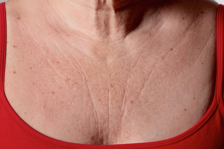 What Causes Wrinkles on Chest