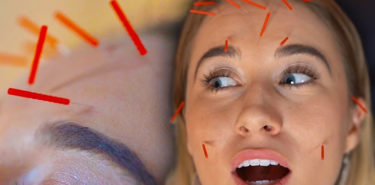 Facial Acupuncture – Everything You Need To Know About It! Facial Acupuncture Everything You Need To Know About It