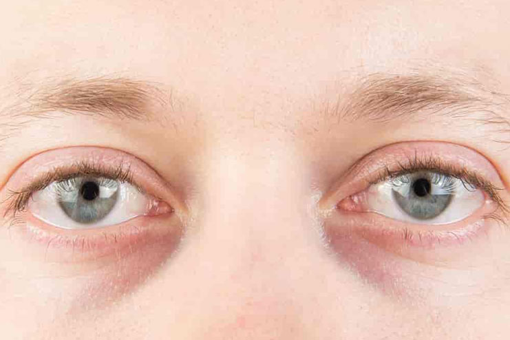 How Effective is Almond Oil for Dark Circles