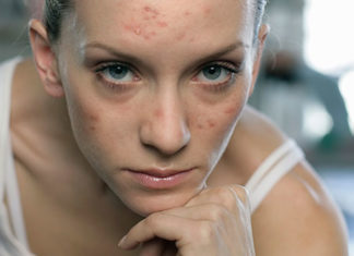 Troublesome Adult Acne – Learn The Solutions To Treat It! Understand It All! Troublesome Adult Acne Learn The Solutions To Treat It Understand It All