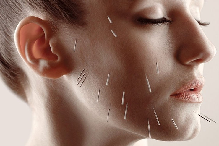 What is Facial Acupuncture